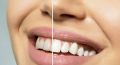 Отбеливание зубов: путь к идеальной улыбке