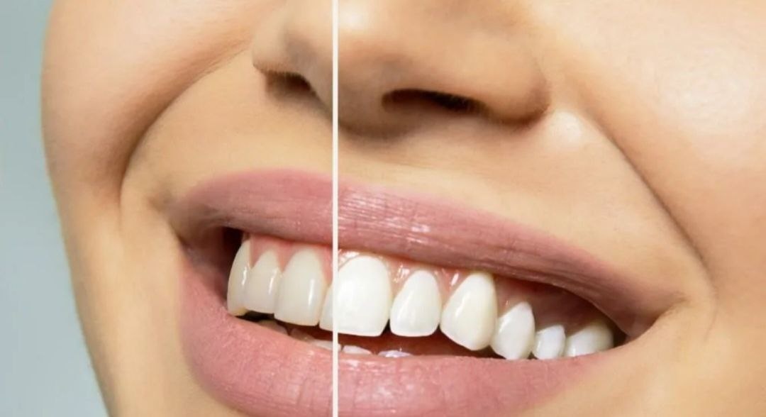 Отбеливание зубов: путь к идеальной улыбке