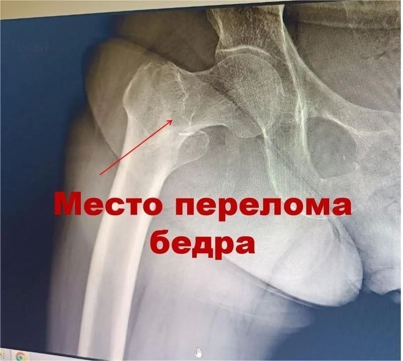 В Усинске сложные переломы теперь лечат без больших разрезов В Усинске сложные переломы теперь лечат без больших разрезов